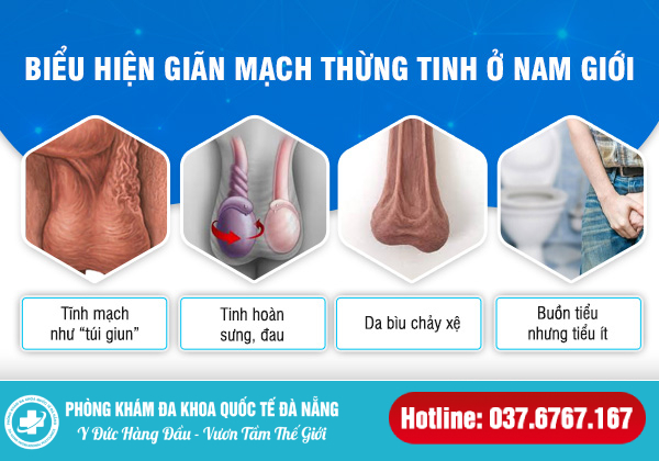 triệu chứng giãn tĩnh mạch thừng tinh