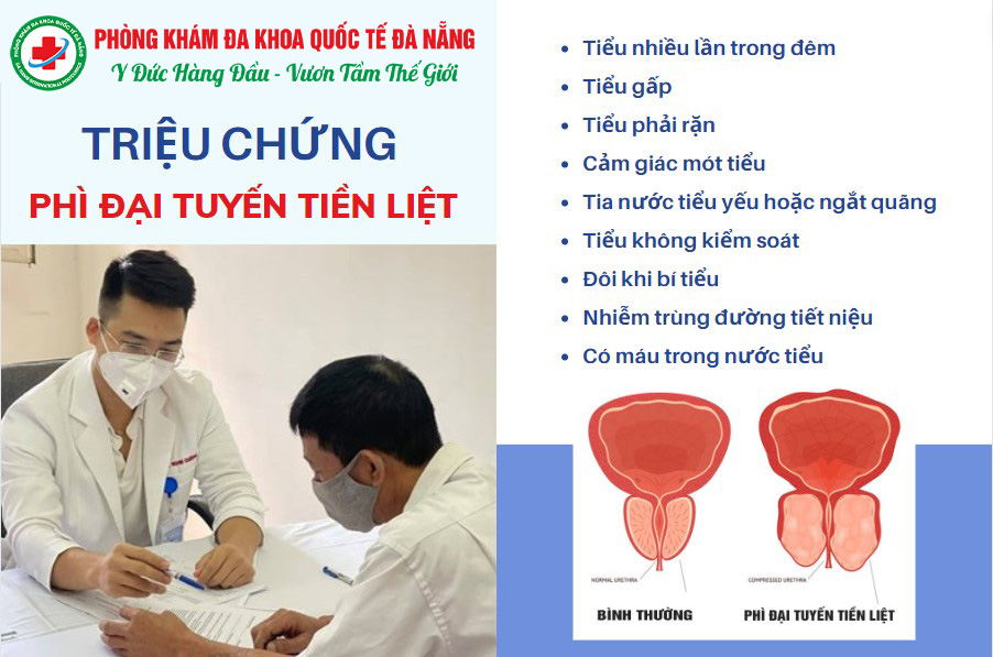 triệu chứng phì đại tuyến tiền liệt