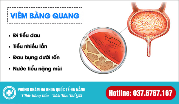 triệu chứng viêm bàng quang