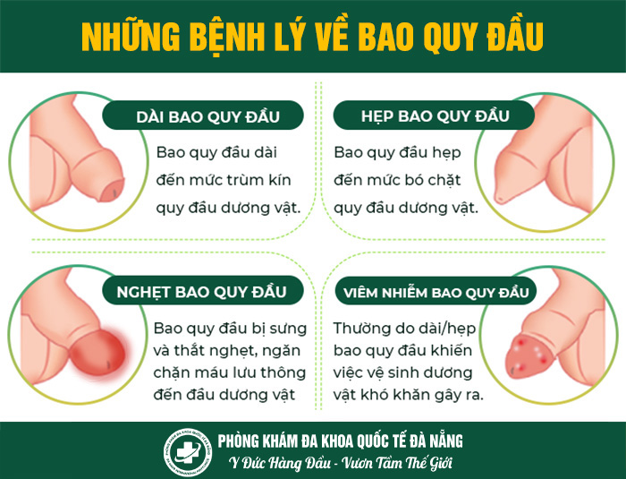 các bệnh lý bao quy đầu nên thực hiện cắt bao quy đầu