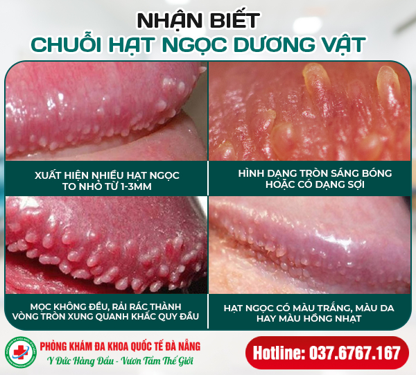 dấu hiệu chuỗi hạt ngọc dương vật
