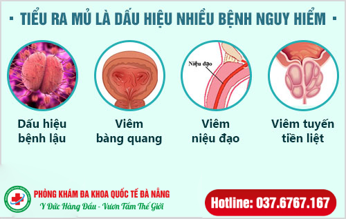 tiểu ra mủ là bệnh gì