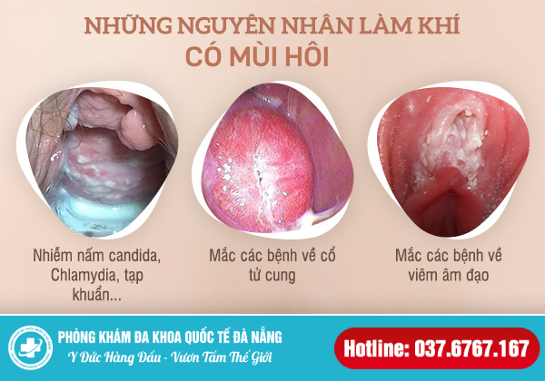 Khí hư có mùi hôi là bệnh gì