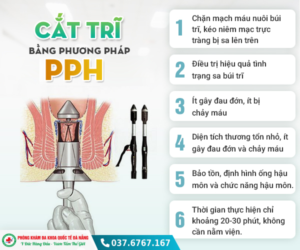 cắt trĩ bằng phương pháp PPH